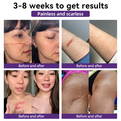 【Limited time discount sale🔥】 Advanced Scar Gel-🏆 Specialized for keloid management🏆